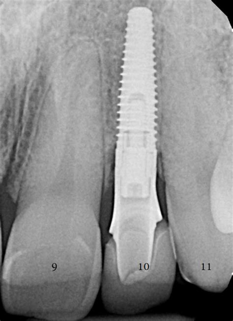 Single Implant Case Puget Sound Periodontics Thomas Kang Dds