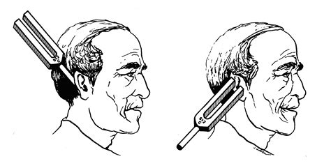 Understanding The Rinne Test A Guide To Administering Interpreting And