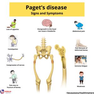 Paget's disease: Signs & Symptoms