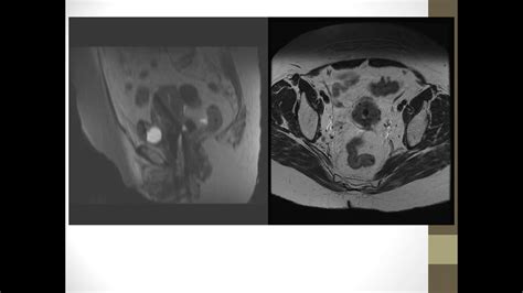 Cervical Brachytherapy Procedure