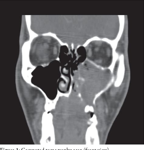 Figure From A Unilateral Maxillary Sinus Tumor Semantic Scholar