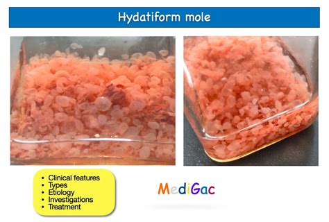 Hydatidiform Mole Clinical Features Types Pathophysiology