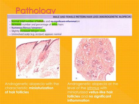 Ppt Androgenetic Alopecia Male And Female Pattern Hair Loss