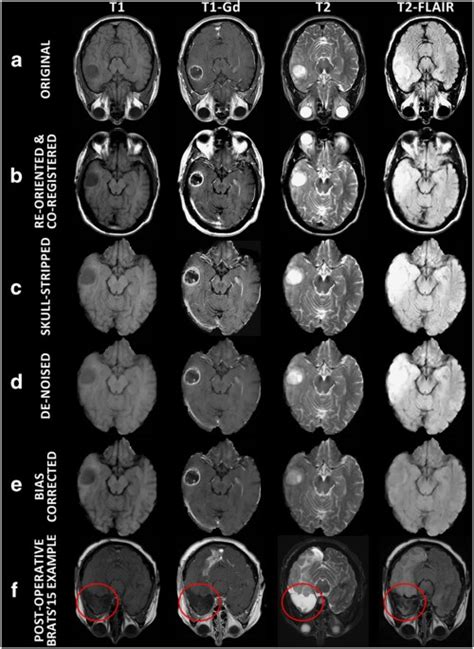 Brain Mri Tumor