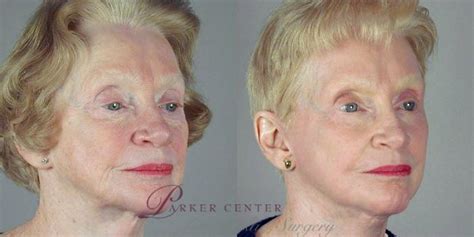 Facelift Before And After Pictures Case 35 Paramus New Jersey Parker Center For Plastic Surgery