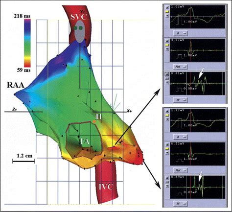 Utility Of Nonfluoroscopic Three Dimensional Electroanatomical Mapping