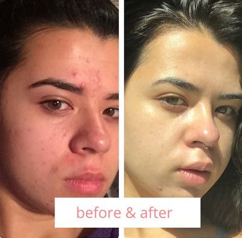 Before and After – Skintify