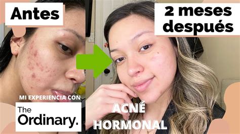 Cómo Curar MÁs RÁpido El AcnÉ Hormonal 2020 Mi Historia Tips Y