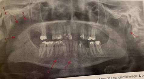 Chapter Normal Anatomy Panoramic Images Normal Anatomic Landmarks