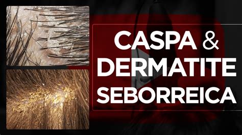 Dermatite Seborreica E Caspa Terapia Capilar E Tricologia YouTube