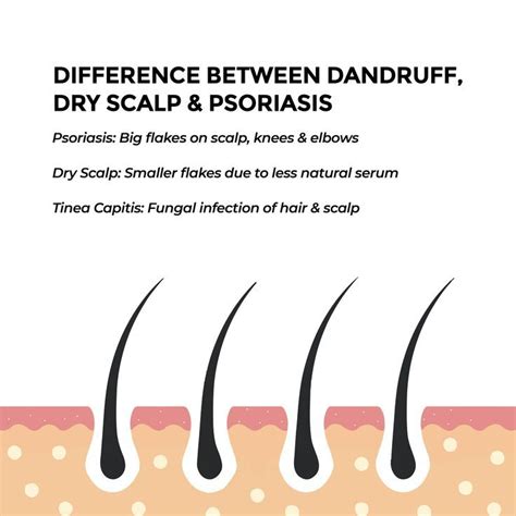 Difference Between Dandruff, Dry Scalp & Psoriasis | By Sublime Life in 2022 | Dandruff, Dry ...