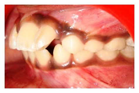 Pretreatment Intraoral Photos Of Fused Maxillary Left Central And