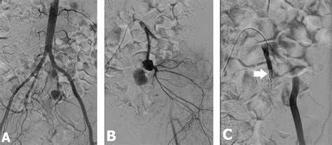 A Arteriography Showed Pseudoaneurysm Of Internal Iliac Artery B A