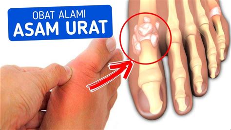 Solusi Ampuh Untuk Menurunkan Asam Urat Cara Menurunkan Asam Urat