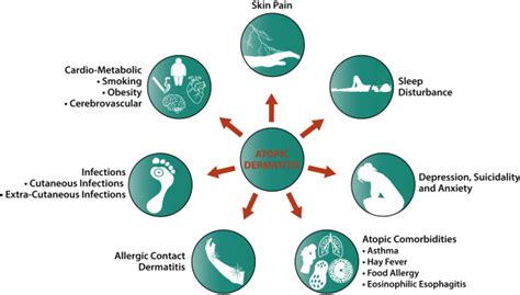 Comorbidities And The Impact Of Atopic Dermatitis Annals Of Allergy Asthma And Immunology