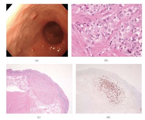 A Gastroscopy Revealed Multiple Elevated Lesions At The Whole Download Scientific Diagram