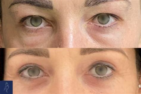 Blépharoplastie inférieure à Paris Traitement des cernes sous les yeux