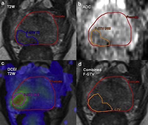 Multi Parametric Mri Guided Focal Tumor Boost Using Hdr Prostate