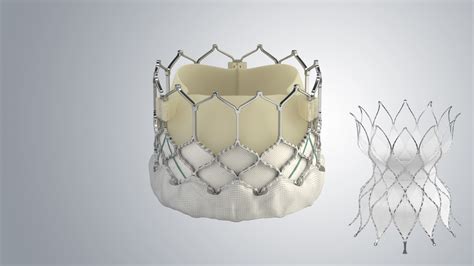 Sapien Con Pre Stent Obtiene La Aprobaci N De La Fda Para La