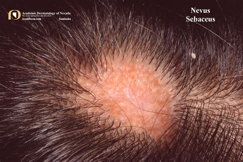 Nevus Sebaceus Of Jadassohn Academic Dermatology Of Nevada