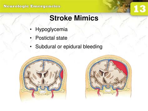 Ppt 13 Neurologic Emergencies Powerpoint Presentation Free Download