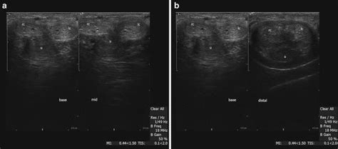 penile ultrasound springerlink
