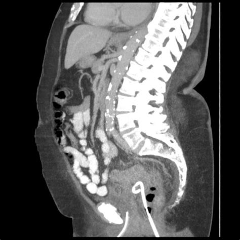 Computed Tomography Scan Of The Abdomen And Pelvis Sag Open I