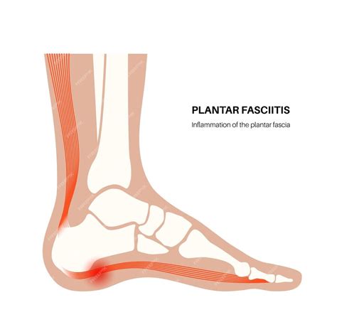 Premium Vector Plantar Fasciitis Anatomical Poster Stretches Or Tears