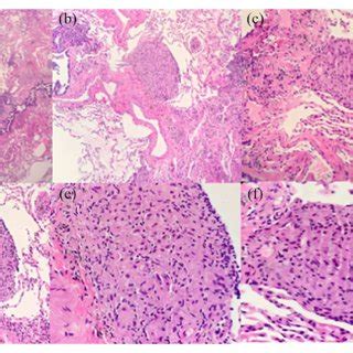 A Multiple Small Discrete Aggregates Of Epithelioid Histiocytes