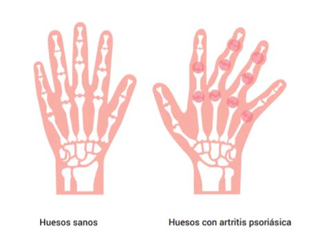 Artritis Psoriásica Qué Es Síntomas Diagnóstico Y Tratamiento