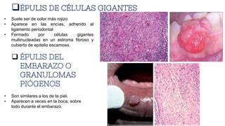 EXPOSICIÓN DE PATOLOGIA SOBRE LA PIELONFRITIS PPT