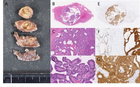 Figure From A Rare Case Of The Recurrent Surgery For Cribriform