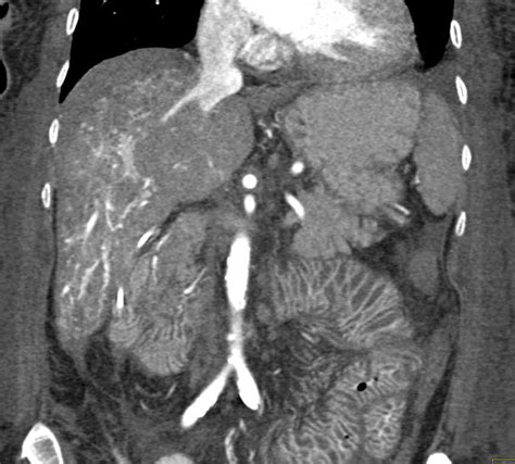 Ctisus Everything You Need To Know About Computed Tomography Ct