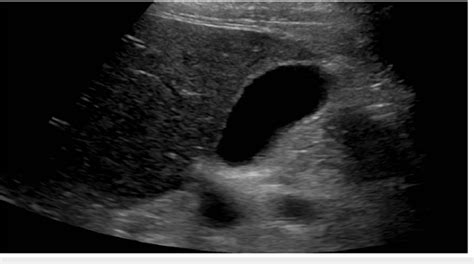 Right Upper Quadrant Ultrasound Revealing An Unremarkable Appearing