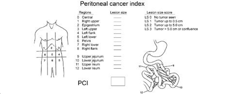 Sugarbakers Peritoneal Cancer Index Download Scientific Diagram