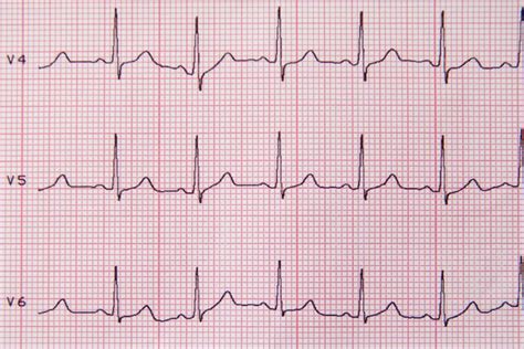 A Man Swallowed a Battery. His Scans Mimicked a Heart Attack ...