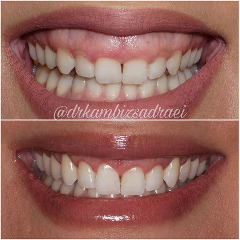 Gummy Smile Surgery Divine Dental Spa El Paso