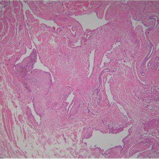 Case Histology Histological Findings Showing Proliferation Of