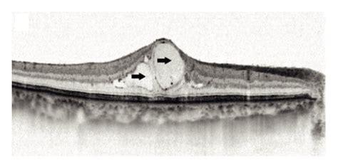 OCT images of different DME types. (a) DME primarily exhibits DRT, with ...