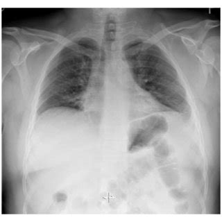 Postoperative Anteroposterior Radiograph Of The Left Shoulder