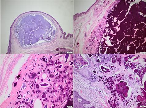 Idiopathic Scrotal Calcinosis A Case Report Abstract Europe PMC