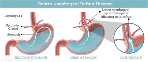 Nissen Fundoplication Indications Types And Risks