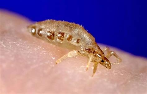 Long term body lice infestation tied to anemia- JAMA