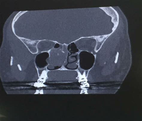 CT scan showing mass involving Rt. nasal cavity | Download Scientific ...