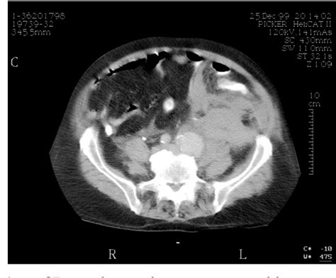 Figure From Successful Treatment Of Ruptured Mycotic Aneurysm Of The