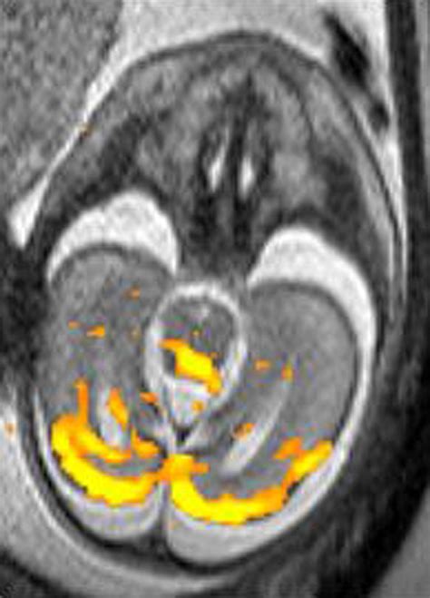 Magnetic Resonance Methods In Fetal Neurology Seminars In Fetal And Neonatal Medicine