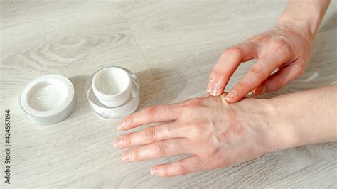 Womens Hands Smeared With Cream Dermatitis On The Hands Dermatitis