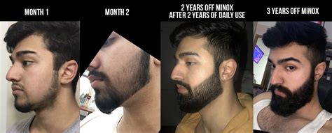 Minoxidil Beard Before And After Reddit Scientist Believe That