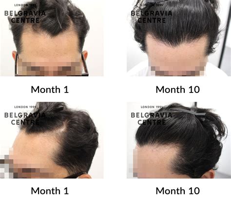 Hair Loss Success Story: "I can definitely see my hair grow back again"