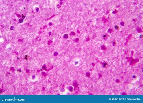 Purulent Meningitis, Light Micrograph Stock Photo - Image of ...